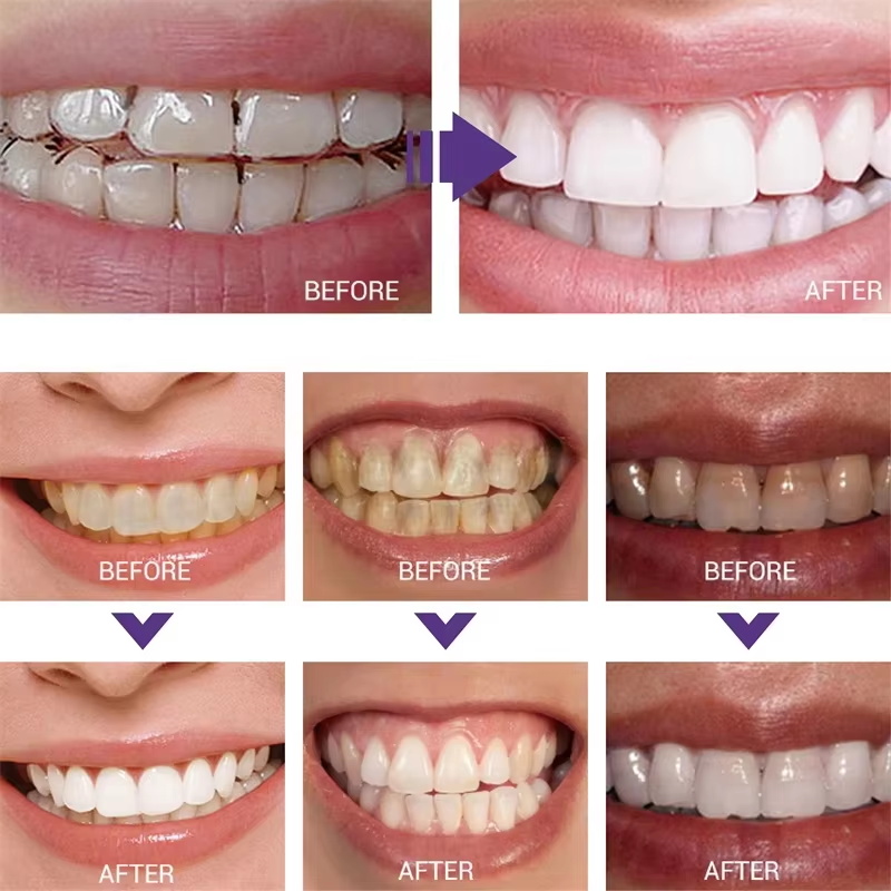 Teeth Cleansing Whitening Toot - đánh giá và giá Teeth Whitening Korea