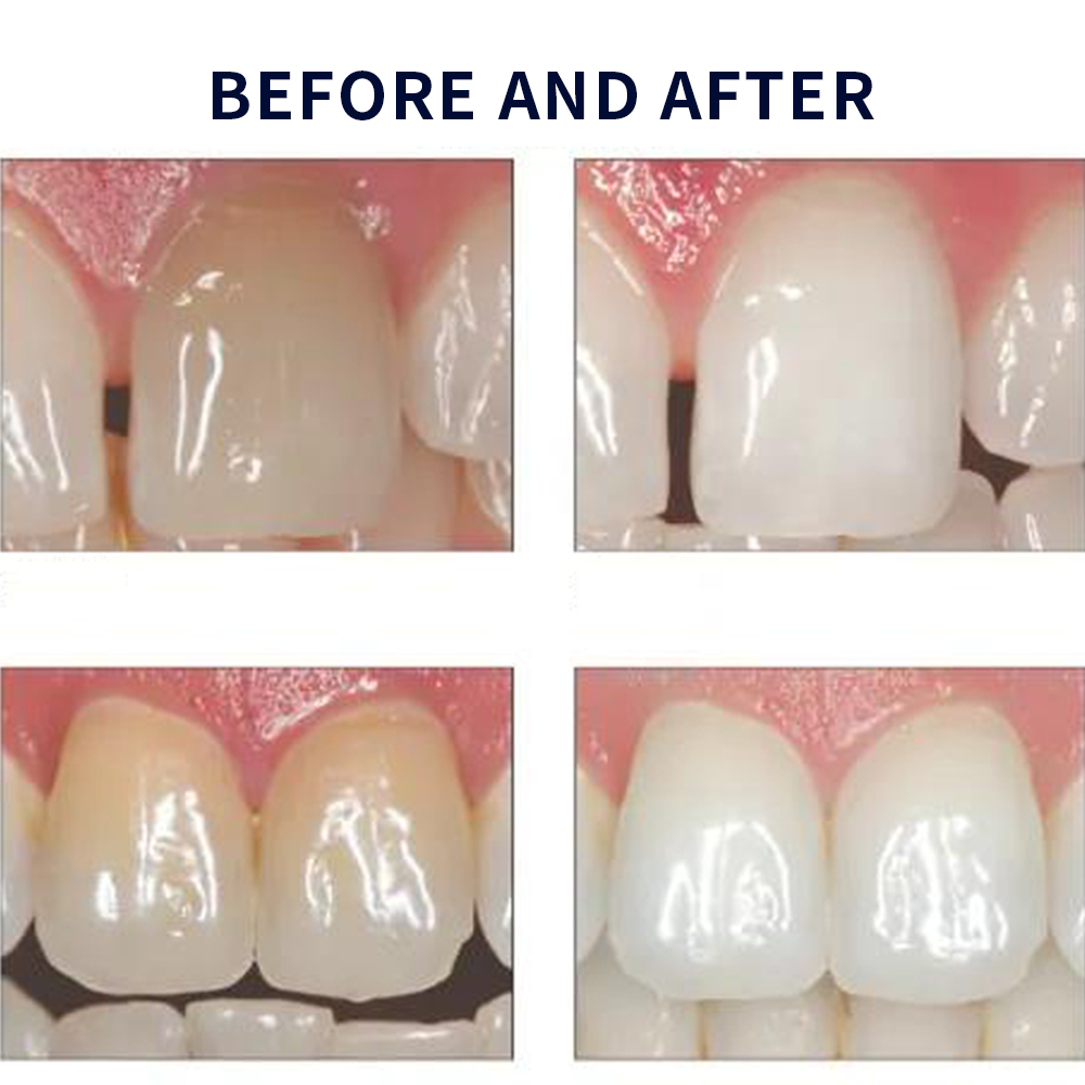 Opalescence Whitening 20% PF 2 - đánh giá và giá Teeth Whitening Remedies