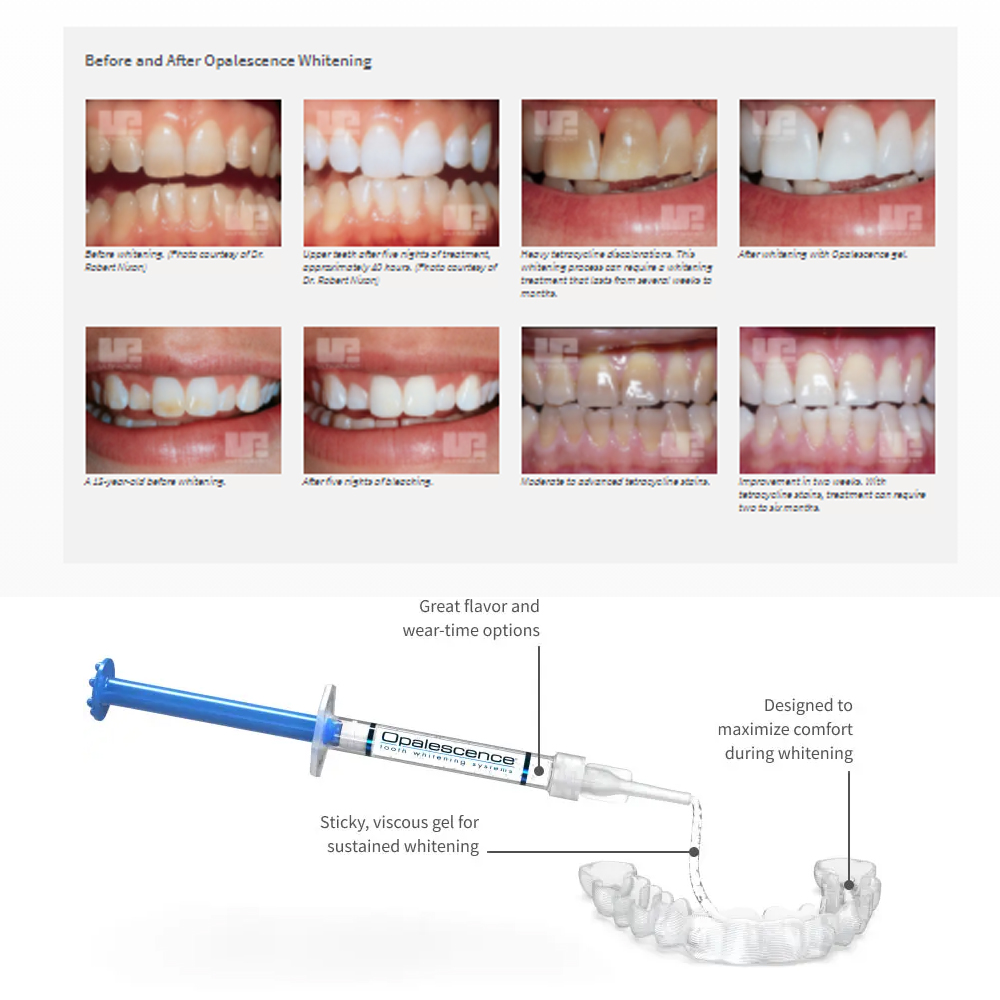 Opalescence Whitening 20% PF 2 - đánh giá và giá Teeth Whitening Remedies